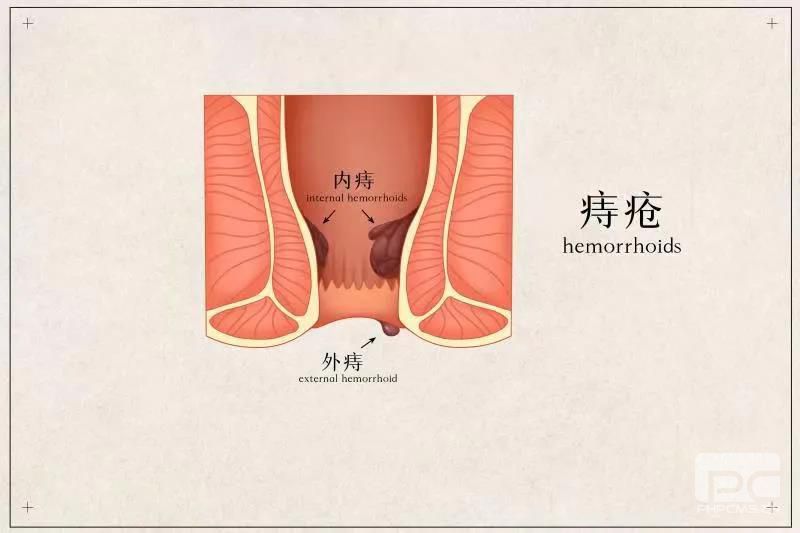 山西肛泰肛肠医院：外痔不治疗会自己变小吗？