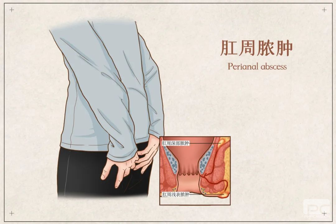 山西肛泰肛肠医院：肛门旁边红肿痛不能拖当心肛周脓肿
