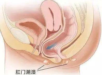 山西肛泰肛肠医院：肛门潮湿总是有分泌物溢出怎么回事？