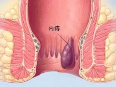 山西肛泰肛肠医院：内痔出血严重吗？