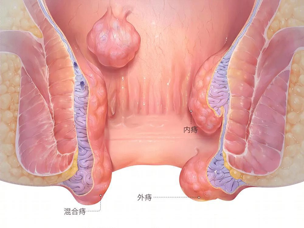 山西肛泰肛肠医院：痔疮误区有哪些