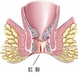 山西肛泰肛肠医院：肛裂疼痛出血怎么办？