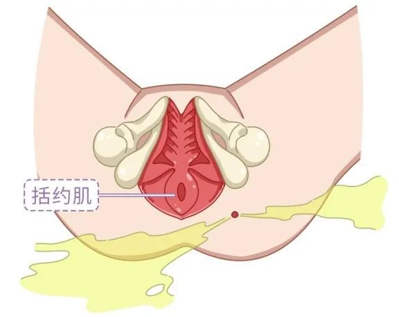 山西肛泰肛肠医院：肛周脓肿必须手术吗？