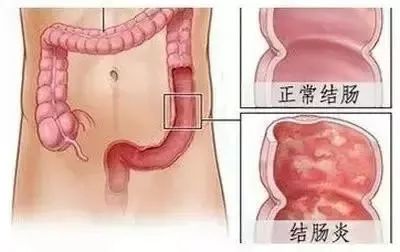山西肛泰肛肠医院：慢性结肠炎的症状都有哪些？
