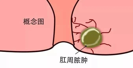 山西肛泰肛肠医院：肛周脓肿需及时治疗，千万别拖延！