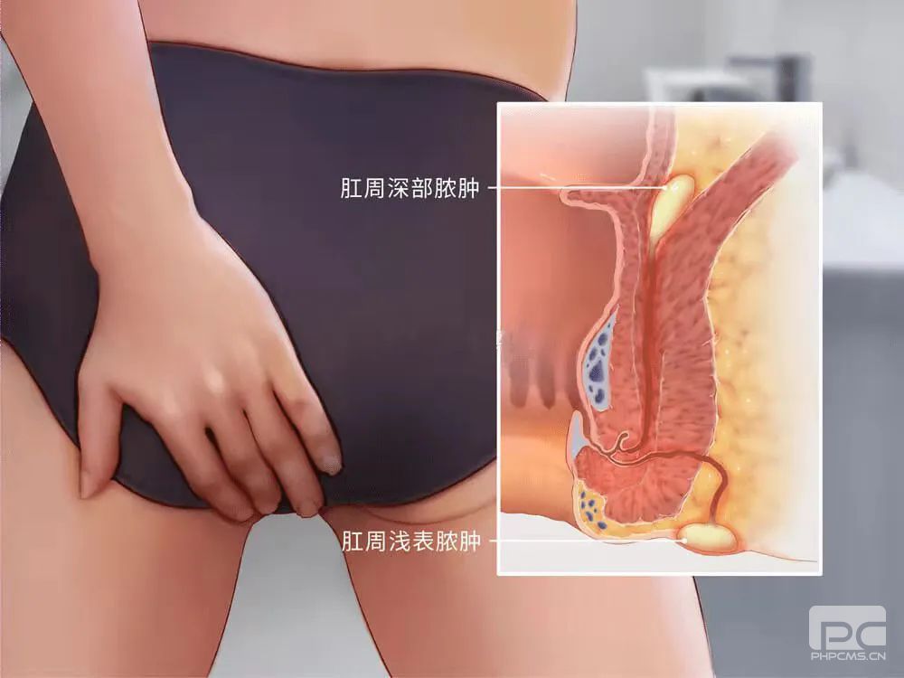山西肛泰肛肠医院：肛周脓肿会产生哪些危害？