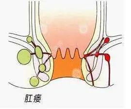山西肛泰肛肠医院：你对肛瘘的危害知多少？