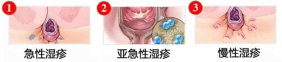 山西肛泰肛肠医院：肛周湿疹的症状是什么？
