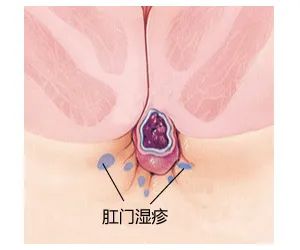 山西肛泰肛肠医院：肛周湿疹的五大误区