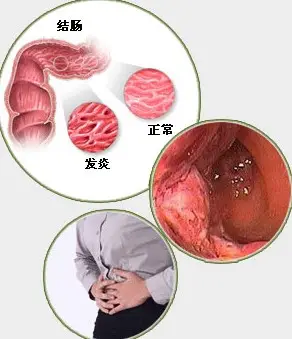 山西肛泰肛肠医院：结肠炎如何预防