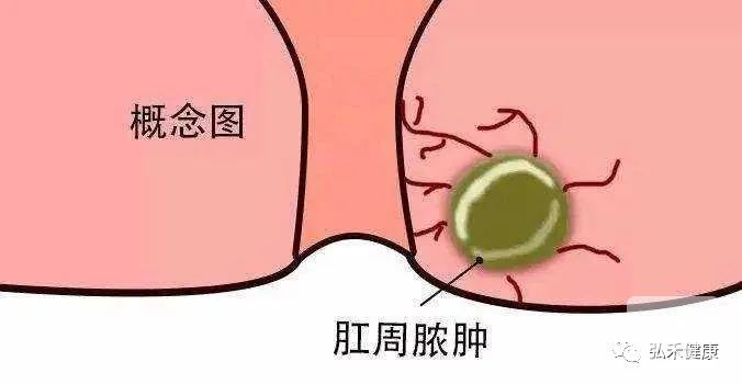 山西肛泰肛肠医院：引起肛周脓肿的三个原因