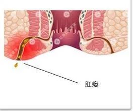 山西肛泰肛肠医院：什么原因会造成肛瘘？