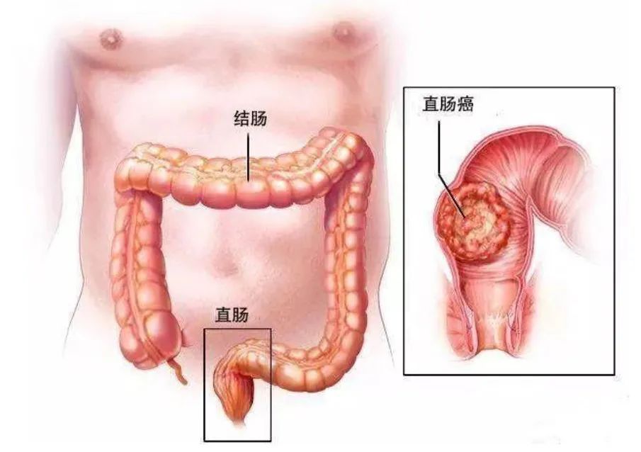 山西肛泰肛肠医院：便血是小病，不用担心？