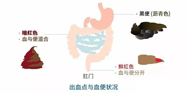 山西肛泰肛肠医院：大便出血四大原因