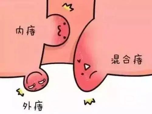 山西肛泰肛肠医院：混合痔的症状是什么？