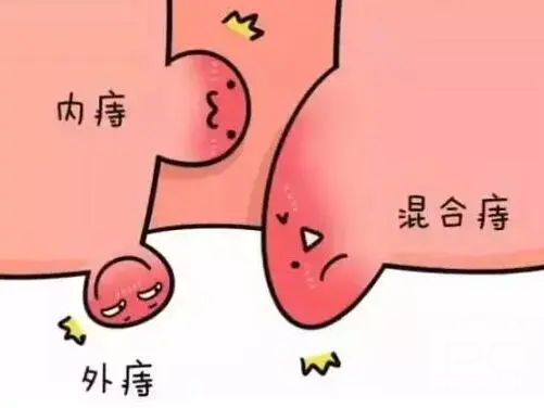 山西肛泰肛肠医院：早期混合痔有哪些症状表现？