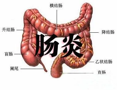 山西肛泰肛肠医院：直肠炎的常见症状有哪些？