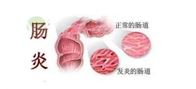 山西肛泰肛肠医院：直肠炎久拖不治可引发哪些疾病？
