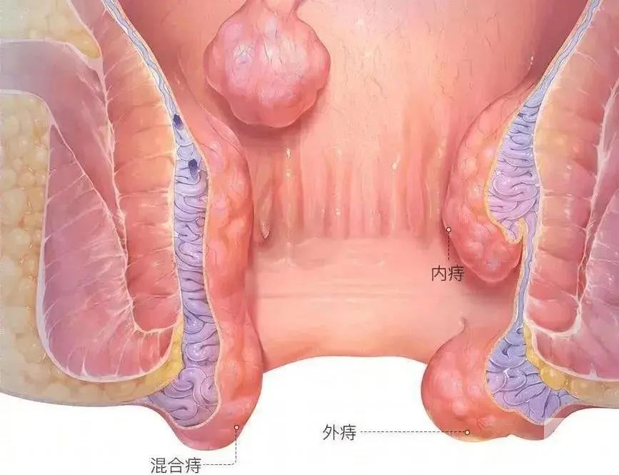 山西肛泰肛肠医院：混合痔是怎么引起的？该如何预防？