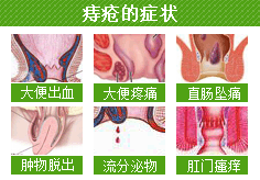 山西肛泰肛肠医院：什么是痔疮？痔疮症状图片？