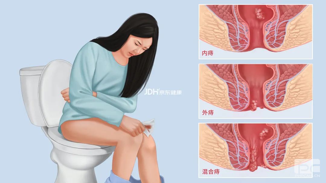 山西肛泰肛肠医院：你的痔疮是什么痔？