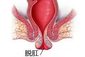 山西肛泰肛肠医院：出现脱肛要注意些什么？