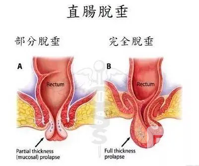 山西肛泰肛肠医院：脱肛了怎么办？