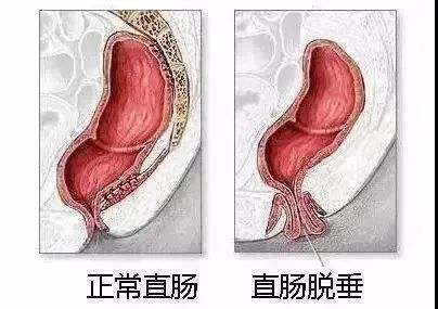山西肛泰肛肠医院：小儿脱肛的原因有哪些？