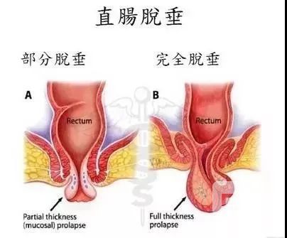 山西肛泰肛肠医院：脱肛就是肠子给拉出来了？