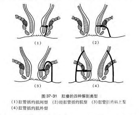 山西肛泰肛肠医院：肛瘘