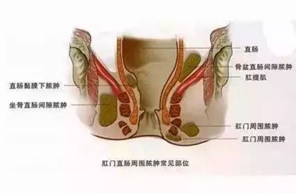 山西肛泰肛肠医院：肛周脓肿不可保守治疗，更不能盲目