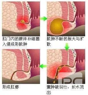 山西肛泰肛肠医院：有这5个症状的朋友 谨防肛瘘找上门
