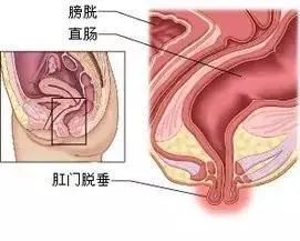 山西肛泰肛肠医院：脱肛是否可以自行恢复？如何养护？