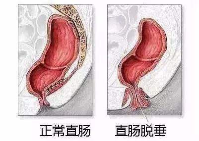 山西肛泰肛肠医院：脱肛是怎么回事呢？