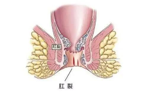山西肛泰肛肠医院：诱发肛裂的五大因素