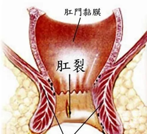 山西肛泰肛肠医院：肛裂应该怎么治疗？