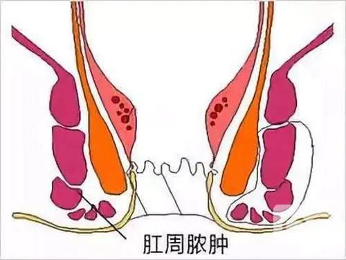 山西肛泰肛肠医院：肛周脓肿怎么消肿？