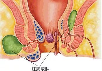 山西肛泰肛肠医院：肛周脓肿治疗要及时，小心恶化惹麻烦！