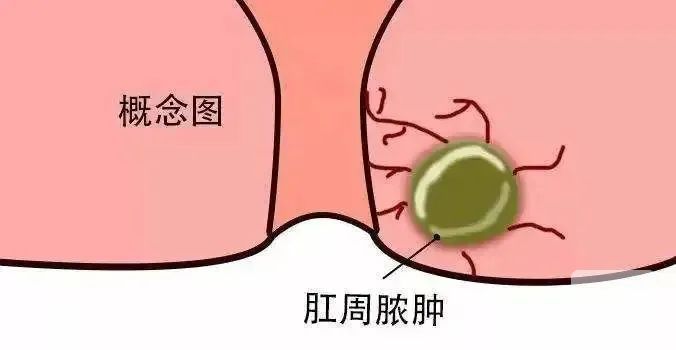 山西肛泰肛肠医院：肛周脓肿更“偏爱”男性是真的吗？