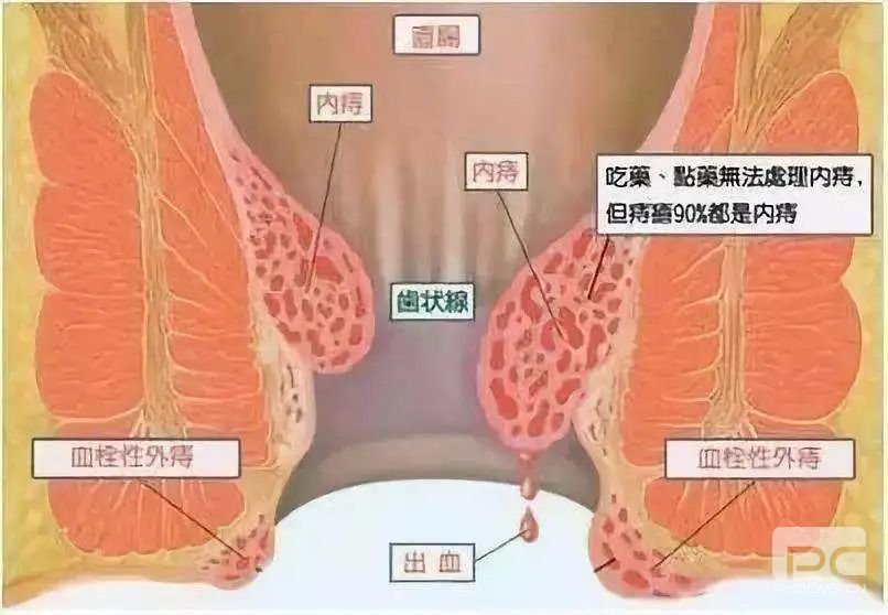 山西肛泰肛肠医院：脱肛，“脱”的到底是什么？