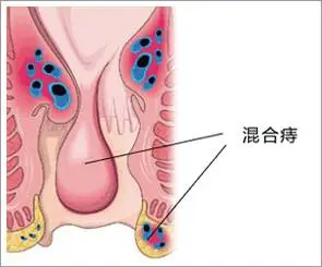 山西肛泰肛肠医院：混合痔治疗/混合痔的诱因及其危害有哪些？