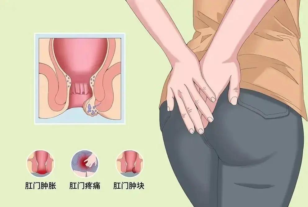 山西肛泰肛肠医院：比痔疮还可怕、还尴尬的肛肠病--肛瘘