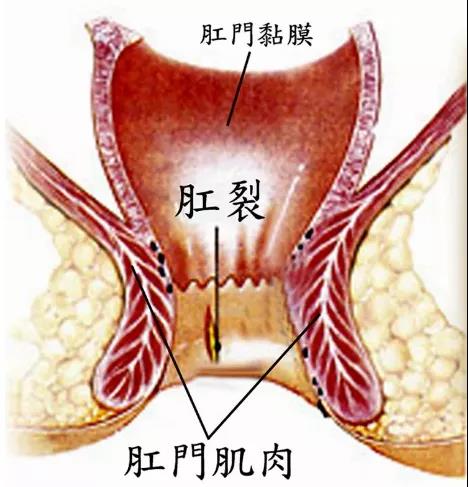 山西肛泰肛肠医院:关于肛裂,怎样做才能有效预防呢?
