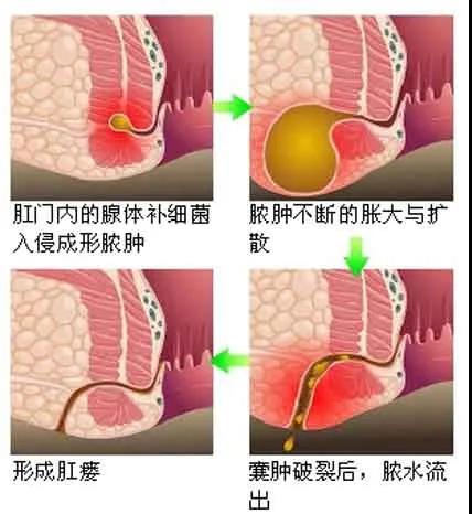 山西肛泰肛肠医院：肛瘘的形成阶段有哪几个？