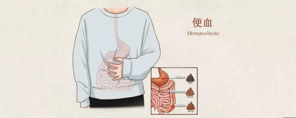 山西肛泰肛肠医院：大便出血就是痔疮吗？