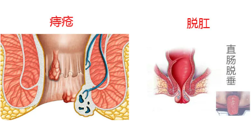 山西肛泰肛肠医院：“脱肛”！希望你不会有这种体验