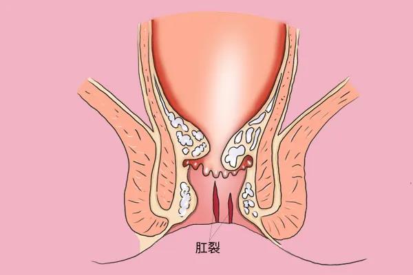 山西肛泰肛肠医院：肛裂难以愈合，可能是这三个原因