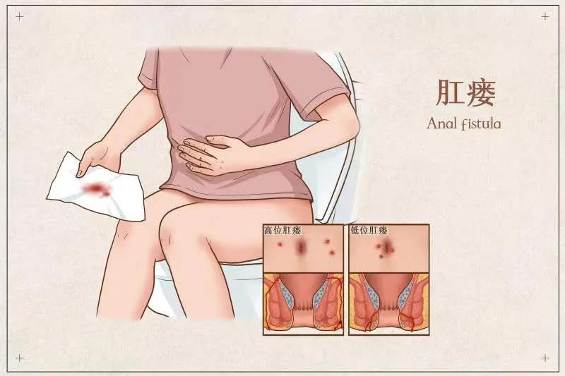 山西肛泰肛肠医院：肛瘘的前期症状有哪些？危害有什么？