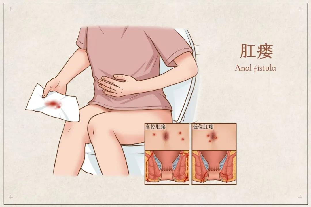 山西肛泰肛肠医院：肛瘘不会自愈！千万不要拖延！