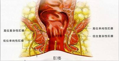山西肛泰肛肠医院：预防肛瘘侵袭，做好这几点